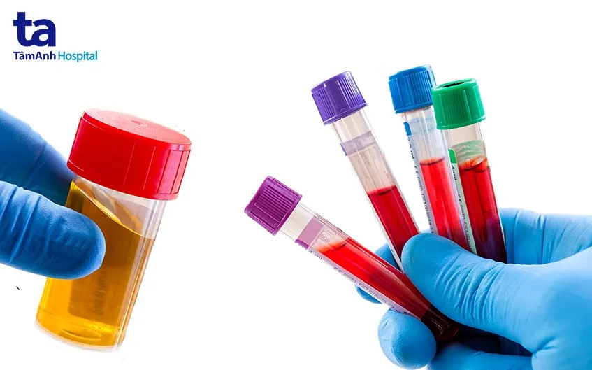 Hình ảnh mô phỏng u bướu ở thận, một nguyên nhân gây tiểu máu