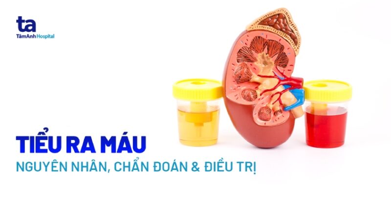 Đi Tiểu Ra Máu: Nguyên Nhân, Triệu Chứng Và Cách Xử Lý