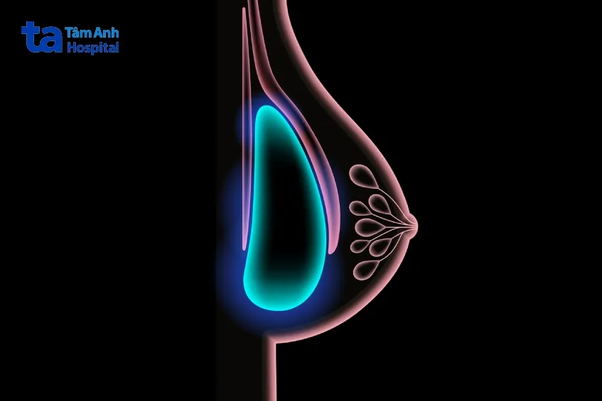 phẫu thuật nâng ngực